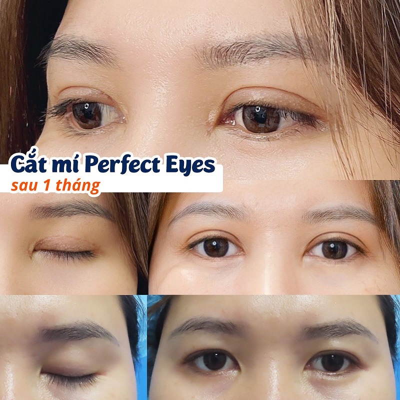 Customer has big, round, balanced, harmonious eyes, no scars left after 1 month of eyelid surgery.