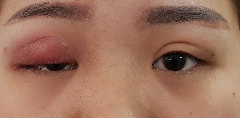 Uneven or too large eyelids are a sign of failed surgery.