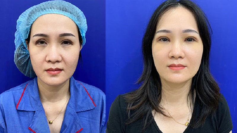 After about 3 - 6 months, the defective eyelid can be repaired
