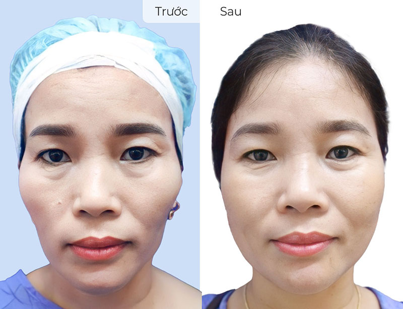 People with thin, gaunt faces should consider facial fat grafting