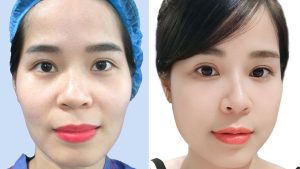 Fat Grafting for Facial Volume Restoration – The Secret to Rejuvenation with Dr. Richard Huy