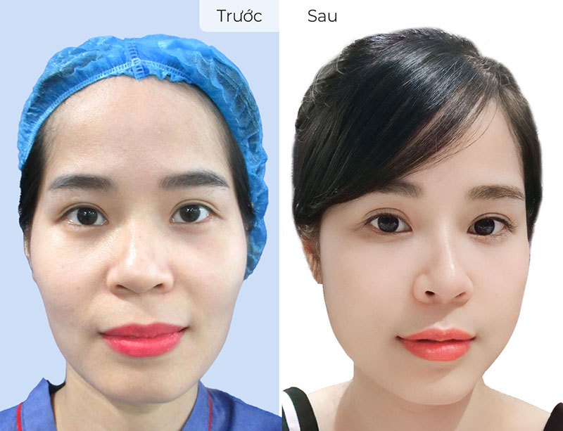 Facial fat grafting helps the face to be balanced and youthful.