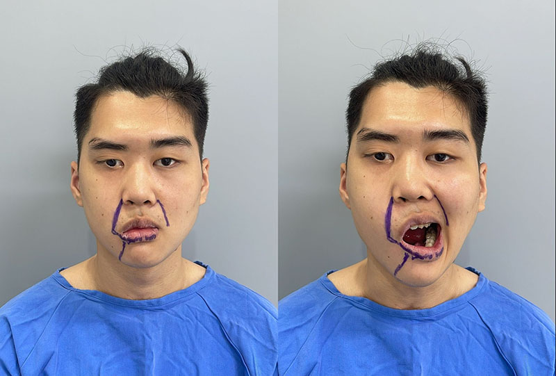 Vu Manh Hung has treated facial nerve paralysis in many places but was unsuccessful.