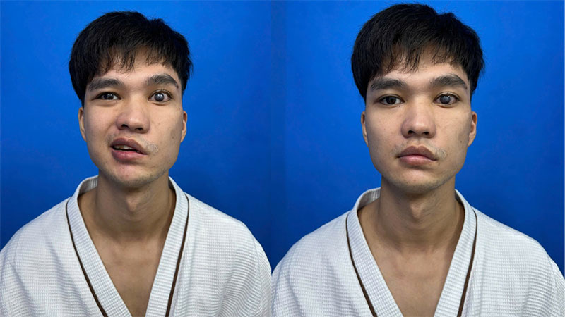 Xuan Toan is a case of facial paralysis causing damage to the left eye. 