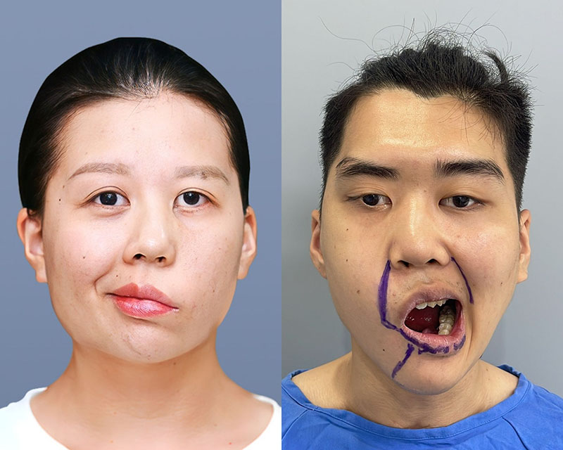 Sequela left after patients suffer from facial nerve paralysis 7