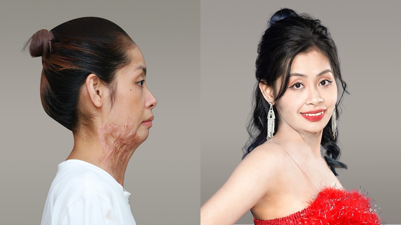 Burn Scar Reconstruction for Diệu Linh – Contestant of the "Journey of Transformation” Season 6