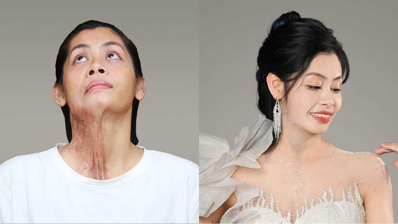 Dieu Linh before and after scar treatment, neck area becomes flexible and easy to move