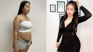 Belly Fat Reduction and Abdominal Etching: A Comprehensive Solution for a Slimmer, More Attractive Waistline