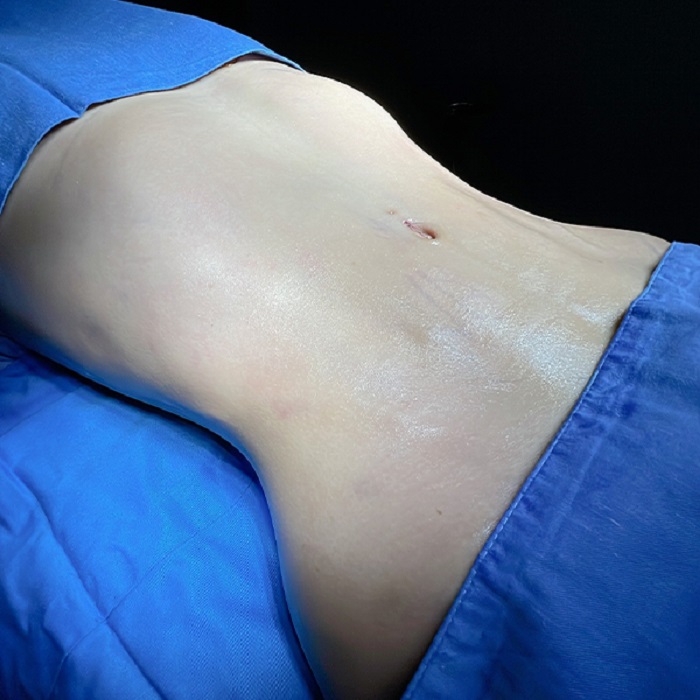 Remove excess fat quickly, safely, and with minimal invasiveness
