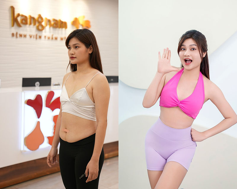 Tiktoker Chi Doi Underwent Combo Fat Reduction for Abdomen, Thighs, and Arms