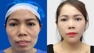 A-Z Guide on Jaw Contouring with Dr. Richard Huy