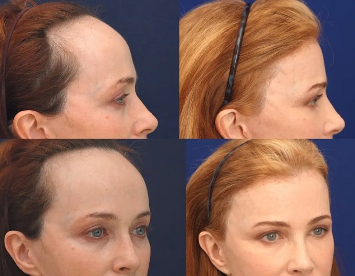 In cases of long, high, and uneven foreheads, this method can be performed.