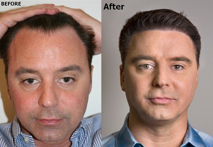 Lowering the Hairline Helps Correct Forehead Imperfections Such as Protruding, Long, or Wide Foreheads