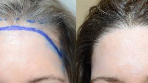 Lowering the Hairline – The Secret to Achieving a Harmonious and Bright Face