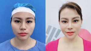 Cheekbone Reduction - Discover the Korean-Standard Surgical Procedure with Dr. Richard Huy