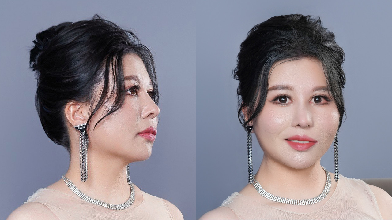 Huyen Trang After Her Transformation, Achieving a Balanced and Natural Face