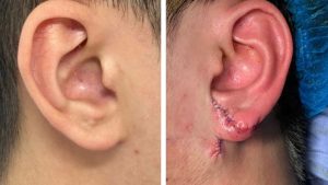 Earlobe Reconstruction Surgery - A Miraculous Process That Brings a New Life to Gia Huy