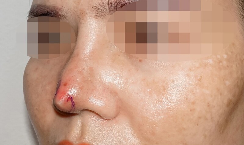 Damaged Nose, Exposed Cartilage after rhinoplasty