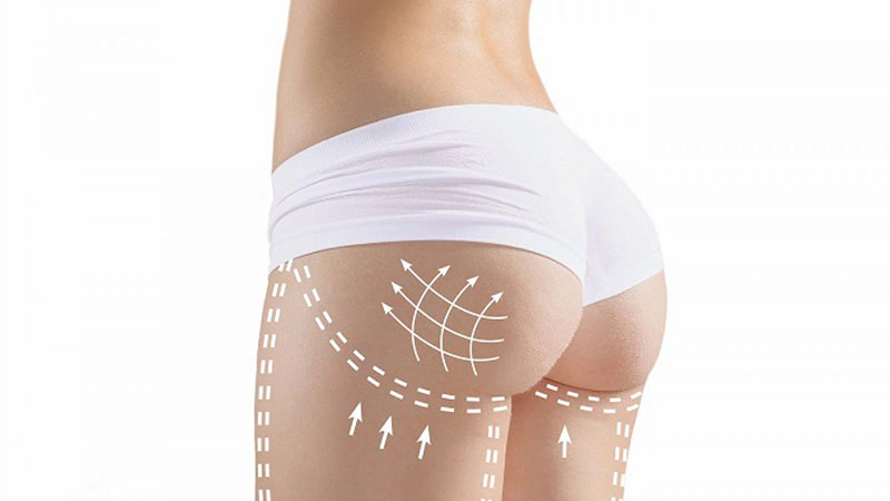 Buttock Augmentation Redefines the Shape and Size of the Buttocks