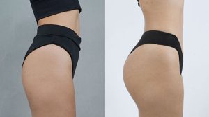 Buttock Augmentation - The Solution for a Full, Attractive Figure