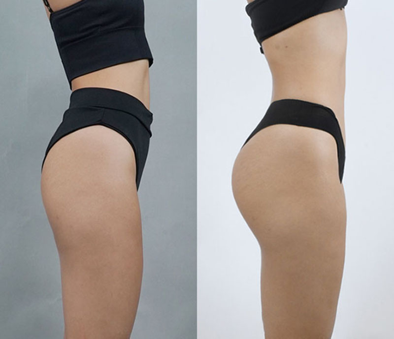 Buttock Augmentation with Implants Provides Stable Results
