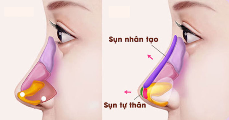 Structural rhinoplasty is a technique to reconstruct the entire structure of the nose.