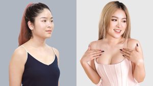 Breast Augmentation by Dr. Richard Huy: Creating a round, beautiful bust for life