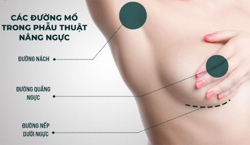 Three Common Breast Augmentation Incision Methods