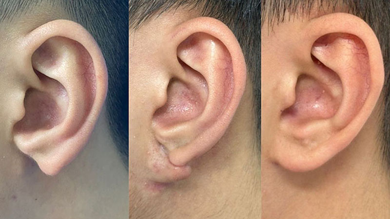 Gia Huy's Transformation Before and After Earlobe Reconstruction