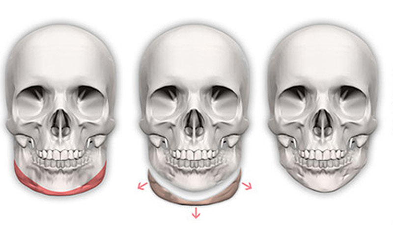 Jaw reduction surgery is a cosmetic surgical procedure that changes the structure of the jawbone. 