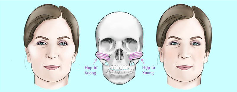 Cheekbone Reduction is an Aesthetic Procedure to Remove Part of the Cheekbone to Reduce Its Prominence