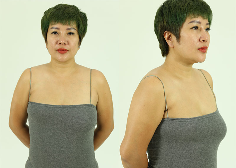 Thu Trang’s Breast Asymmetry Due to Surgery Removing 1/3 of Her Right Breast from Breast Cancer