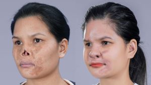 Doctor Richard Huy Restores the 'Missing' Nose for a Gen Z Girl