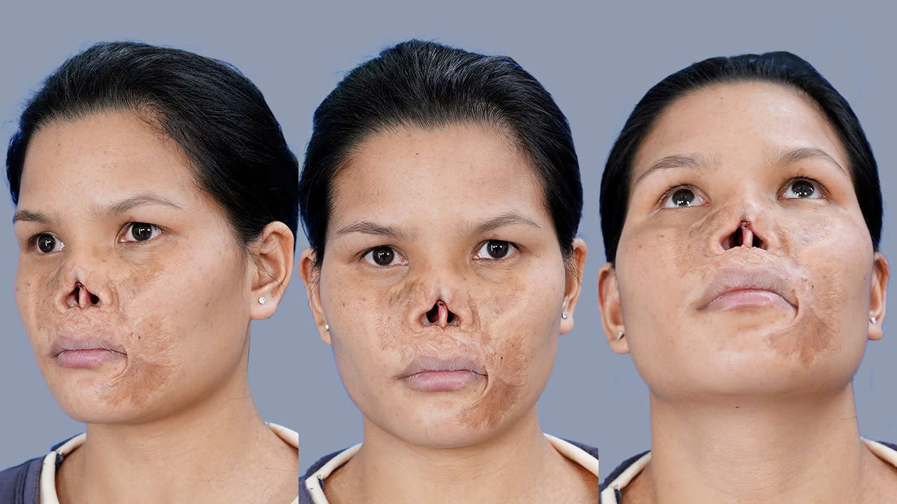 The Near 'Disappearance' of Lo Thi Le’s Nose