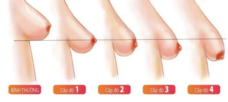 Levels of Breast Sagging