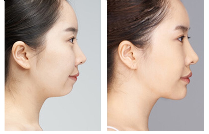 Those with recessed or asymmetrical chins should consider chin sliding.