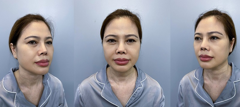 Ms. Bui Thi Thu Hoai Before Cosmetic Surgery