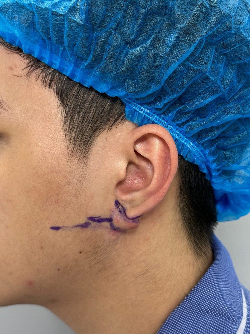 First-time surgery with autologous skin flap grafting and nurturing