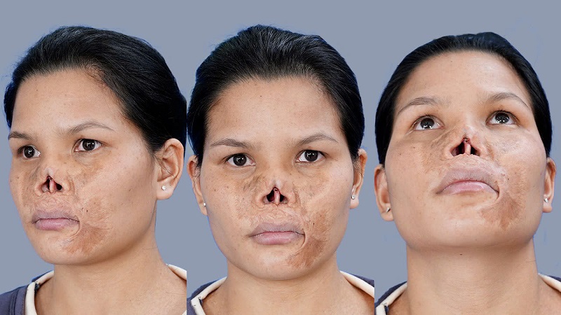 Lo Thi Le's Condition of Having No Nasal Bridge