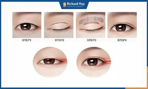 Các bước phẫu thuật thẩm mỹ mắt to Các bước phẫu thuật thẩm mỹ mắt to