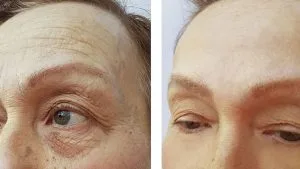 Căng da trán không phẫu thuật - Dr. Richard Huy giải đáp thắc mắc