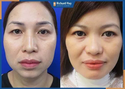 Chân mày sụp, chảy xệ, mỡ dư thừa phù hợp với nâng cung chân mày 