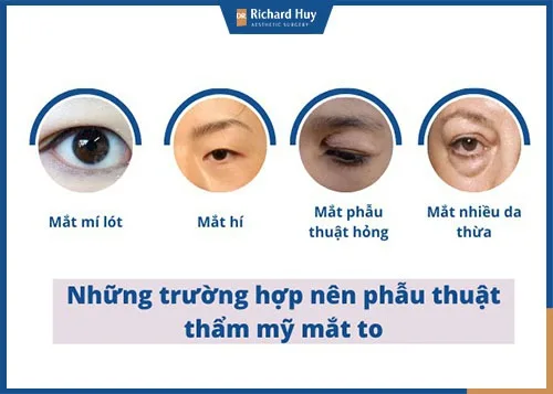 Trường hợp nên phẫu thuật thẩm mỹ mắt to hơn Trường hợp nên phẫu thuật thẩm mỹ mắt to hơn