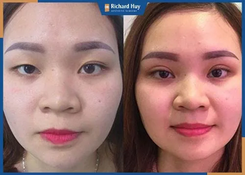 Kỹ thuật xử lý vùng mỡ mí mắt trên và bọng mắt từ đó giúp đôi mắt to hơn Kỹ thuật xử lý vùng mỡ mí mắt trên và bọng mắt từ đó giúp đôi mắt to hơn