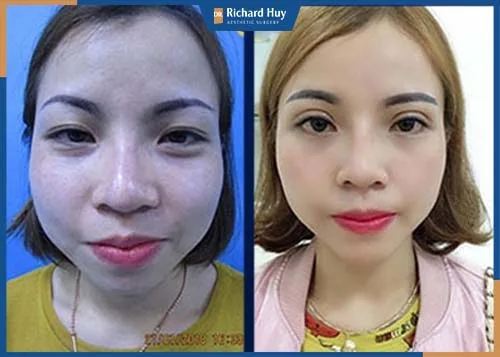 Kỹ thuật thực hiện giúp mắt to và điều chỉnh cơ nâng mi Kỹ thuật thực hiện giúp mắt to và điều chỉnh cơ nâng mi