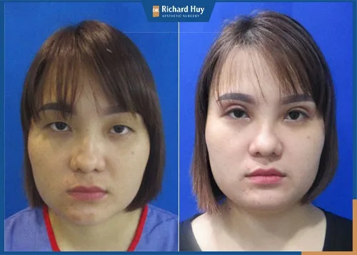 Phẫu thuật thẩm mỹ mắt to giúp khắc phục toàn diện các khuyết điểm vùng mắt Phẫu thuật thẩm mỹ mắt to giúp khắc phục toàn diện các khuyết điểm vùng mắt