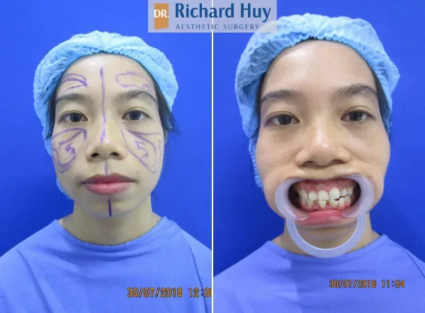 phẫu thuật thẩm mỹ