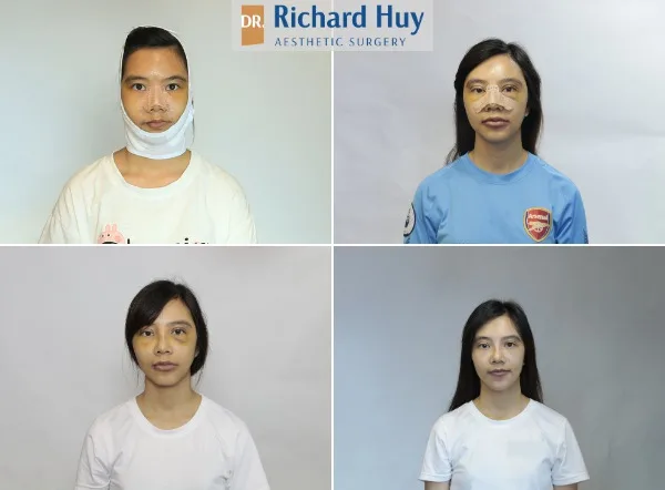 phẫu thuật thẩm mỹ