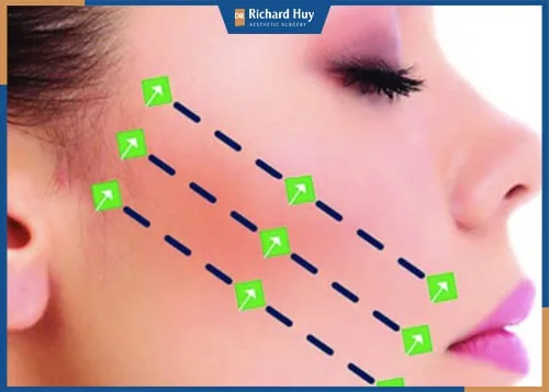 Loại chỉ tự tiêu Loại chỉ tự tiêu