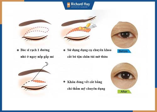 Kỹ thuật loại bỏ phần da, mỡ thừa cho đôi mắt to tự nhiên hơn